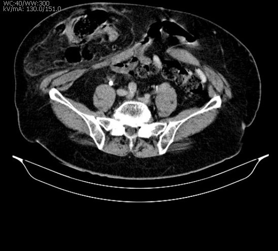 Tomografia Abdominal Preço 